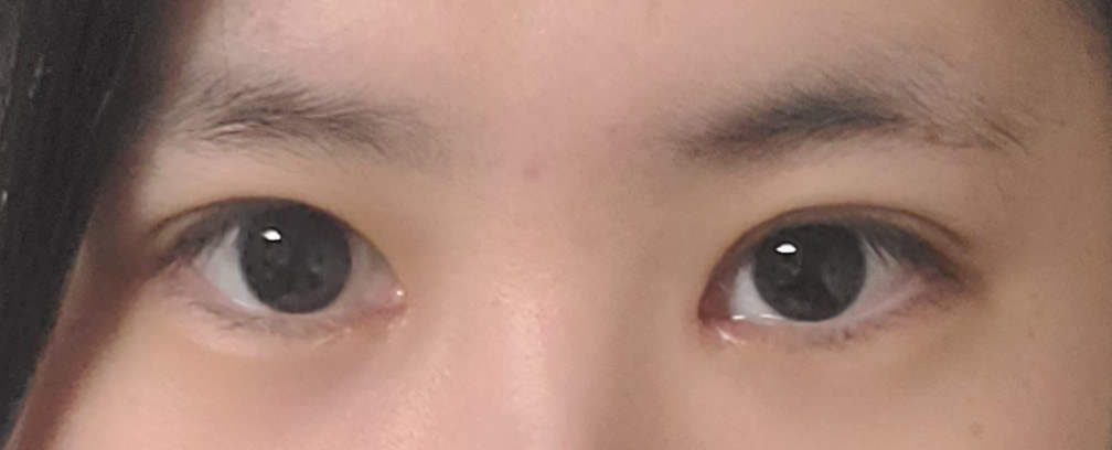 수술후기이미지
