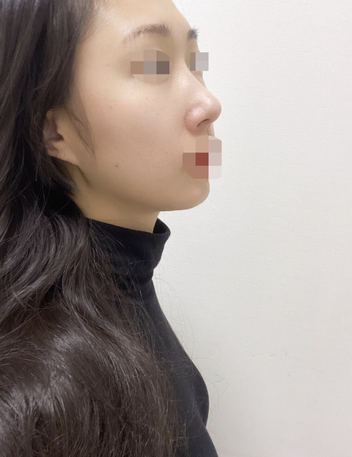 수술후기이미지