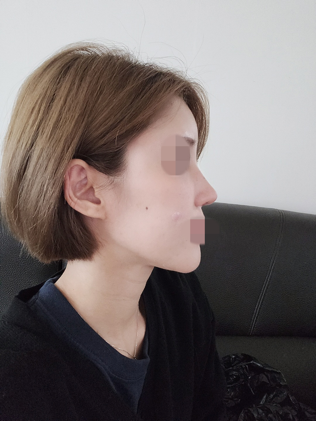 수술후기이미지