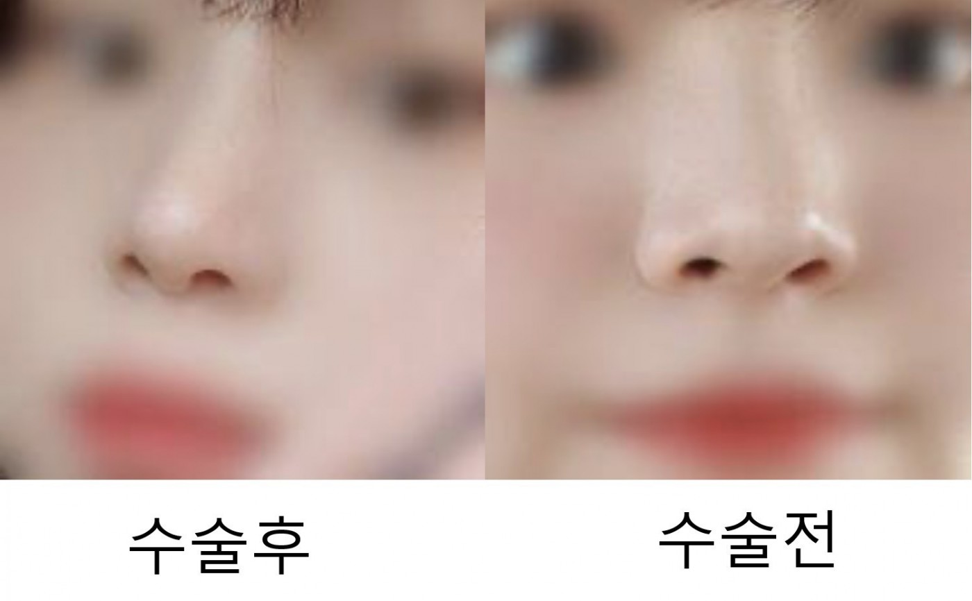 콧대 코끝 수술후기예요!