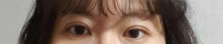 수술후기이미지