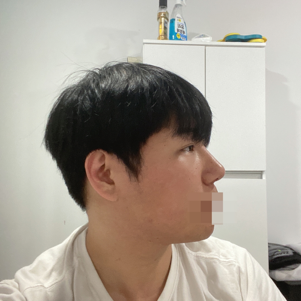 수술후기이미지