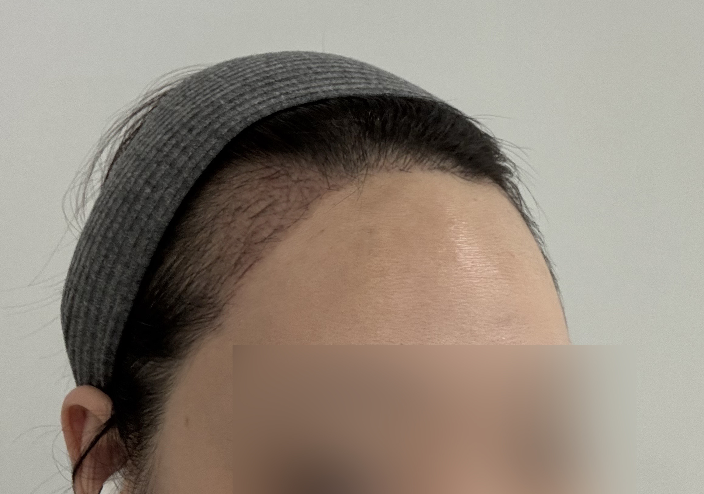 수술후기이미지