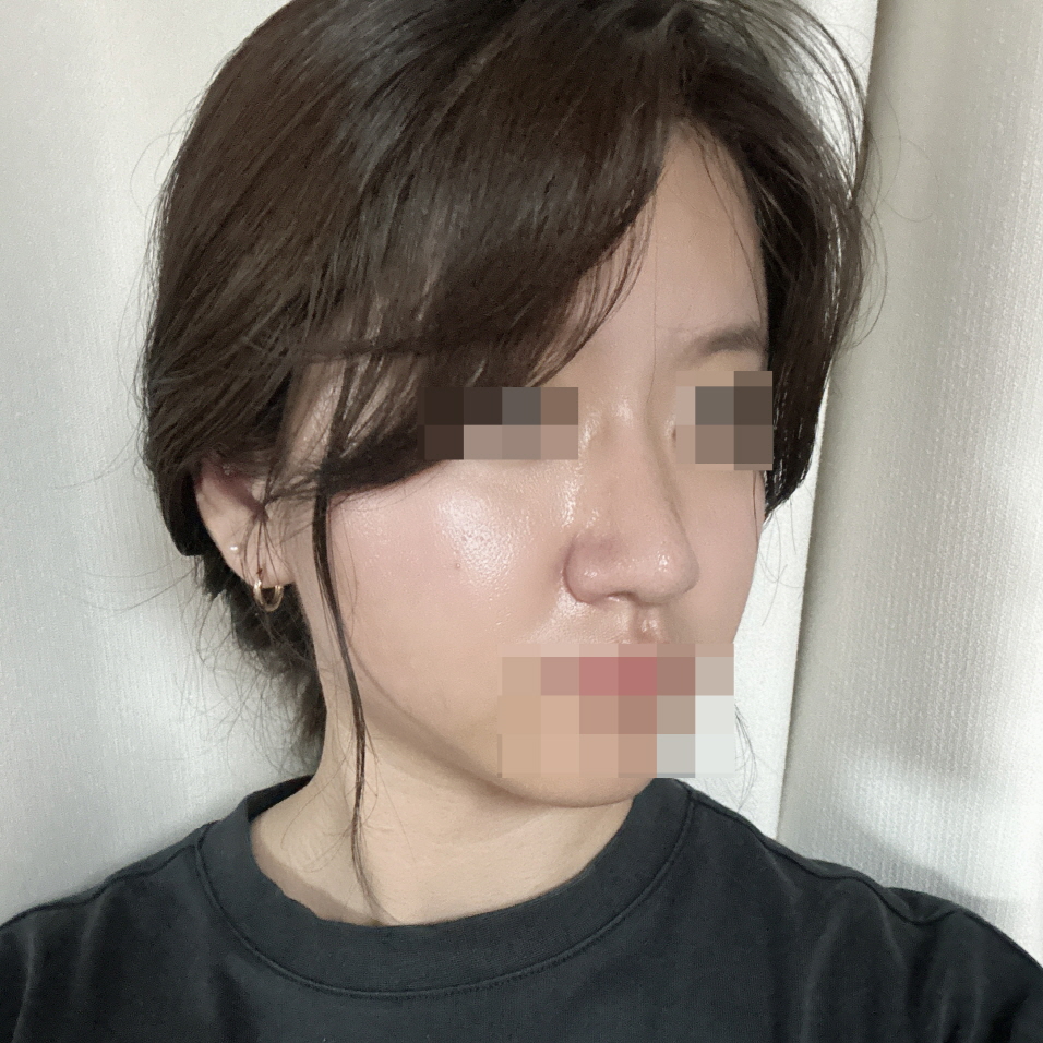 수술후기이미지