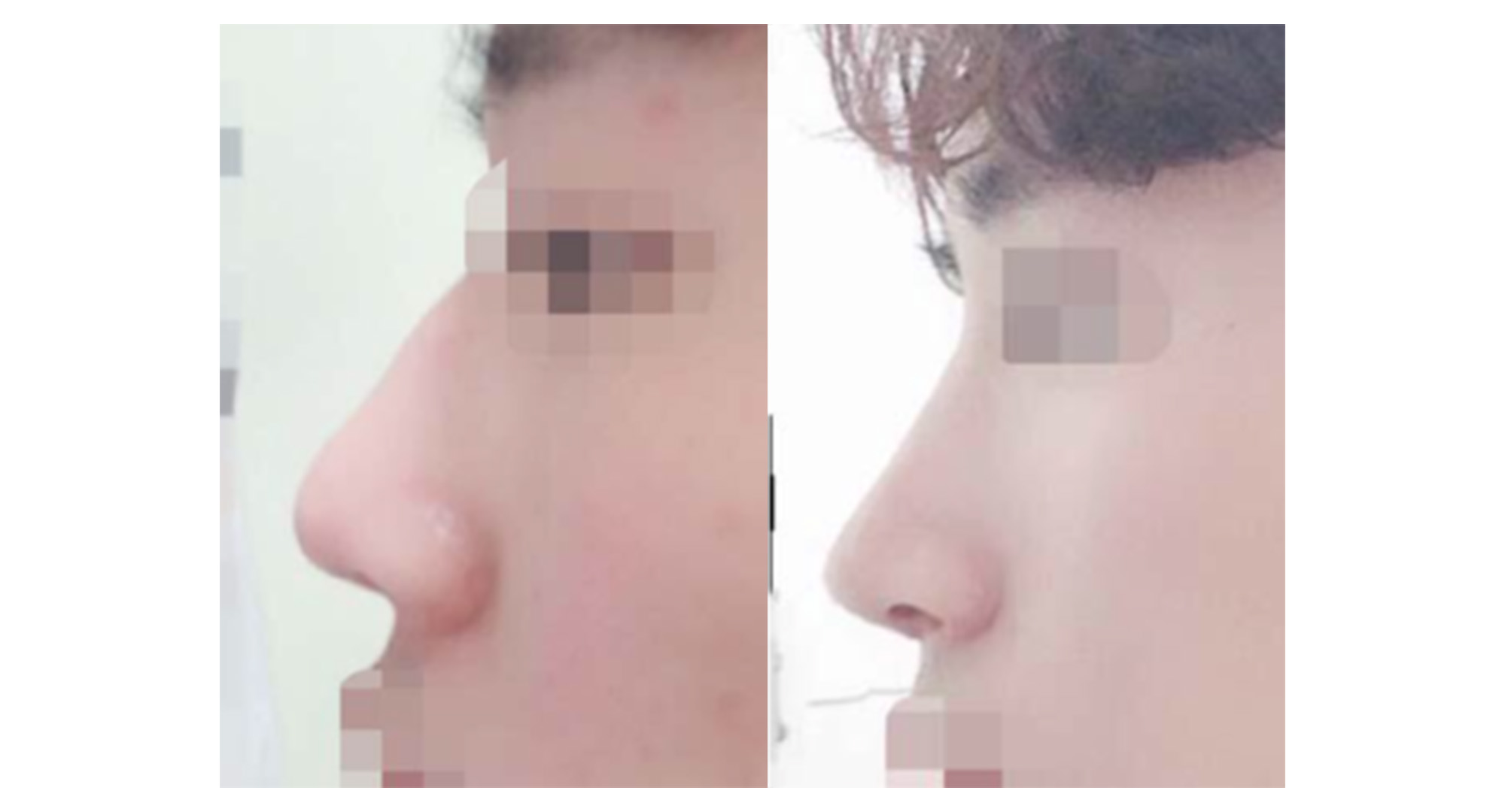 메부리코 교정 1개월 후기