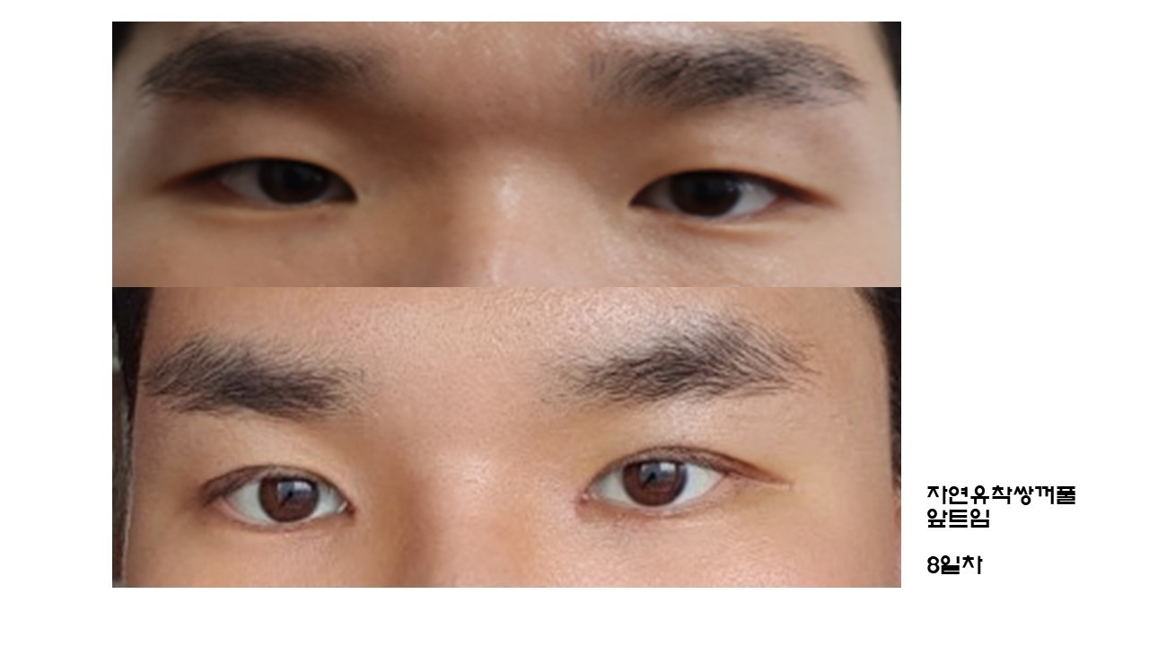 수술후기이미지