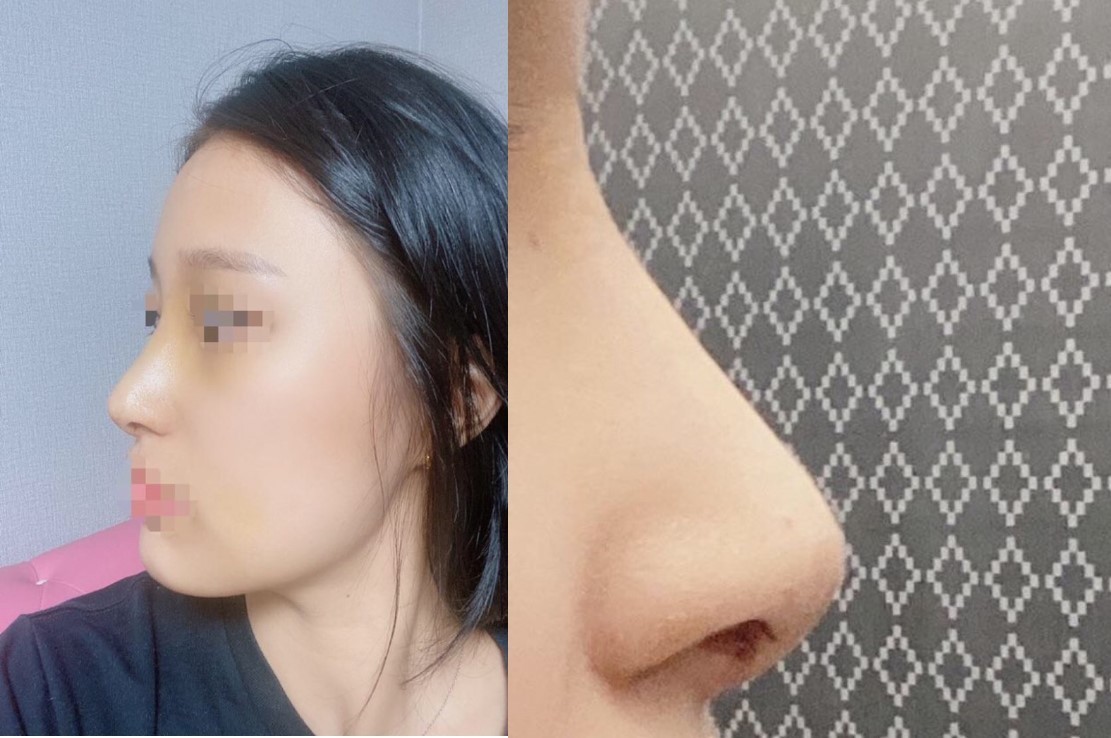 수술후기이미지