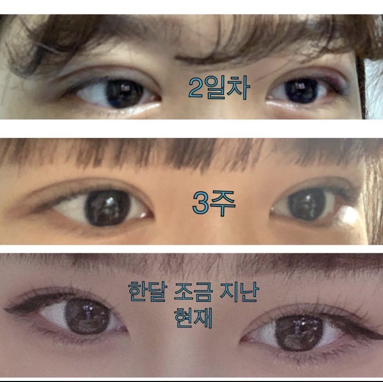 수술후기이미지