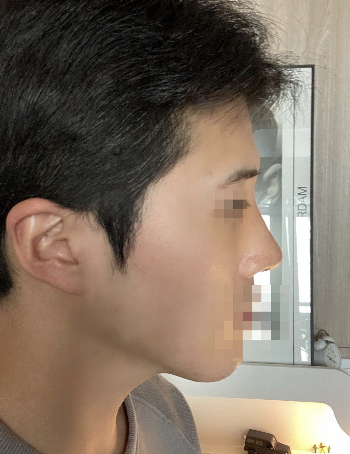 수술후기이미지