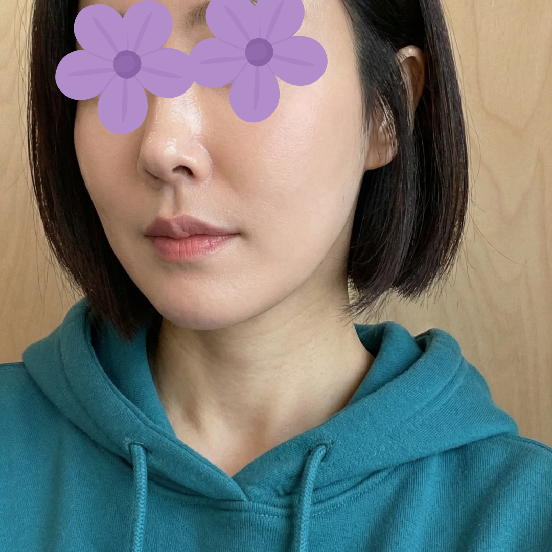 수술후기이미지