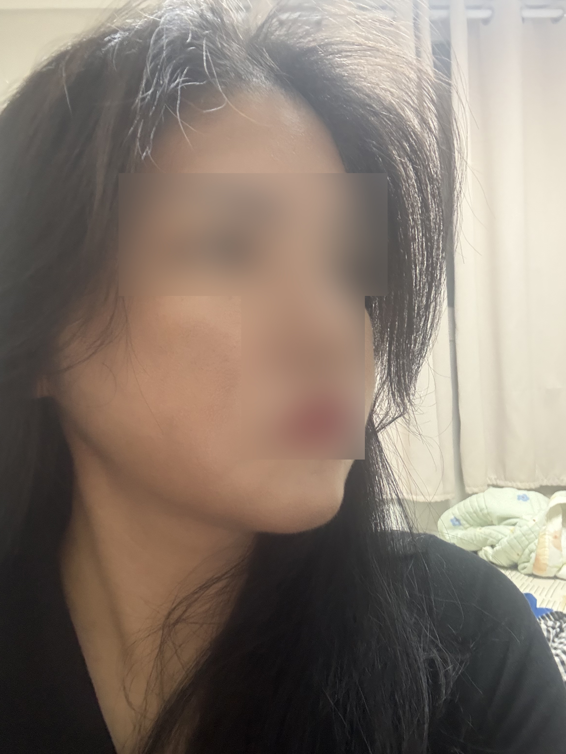 시간이 지날수록 더 만족스러운 턱라인, 4개월차 후기