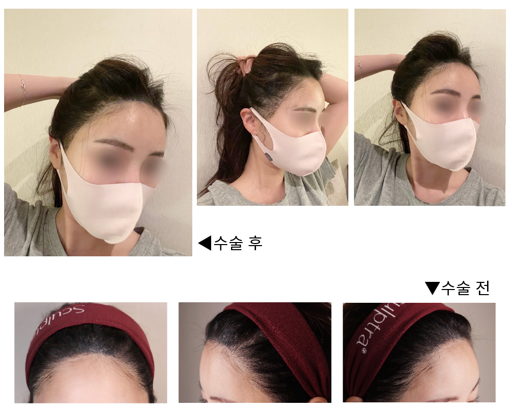 수술후기이미지